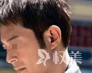 武汉洪山万禾盛植鬓角 提升自信