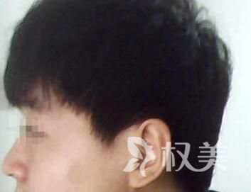 的植发医院是哪家 济南海峡做鬓角种植怎么样
