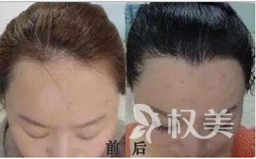 杭州瑞丽诗植发医院种美人尖后 颜值提升了一大截