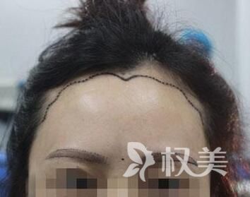 无锡坤如玛丽植发价格费用 美人尖种植多少钱