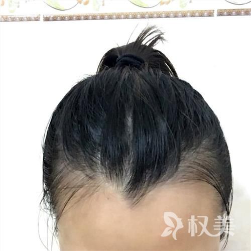 美人尖种植怎么样 天津雍禾植发医疗整形医院好不好