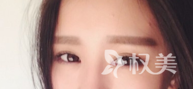 眉毛种植是什么 东莞雍禾植发整形医院眉毛种植怎么样
