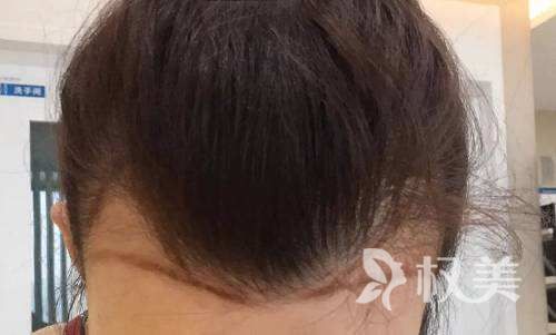发际线种植贵不贵呢 上海九院植发整形科靠谱吗