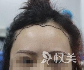 植发3个月毛囊全掉了 成都思发源美人尖种植多久见效