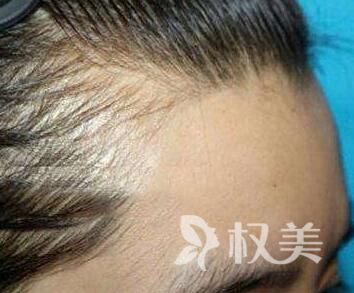 北京中德植发医院种发际线怎么样 价格贵不贵