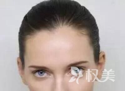 广西武警总队医院植发怎么样 种发际线要多少钱