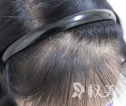 植发三年后掉光是怎么回事 上海科发源头发种植能保持多久