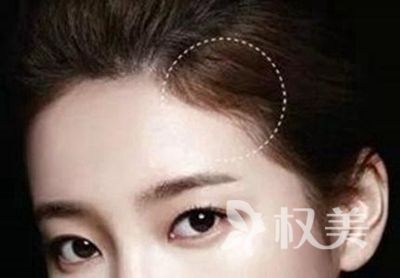 发际线过高怎么办 重庆重生毛发移植医院发际线种植好吗