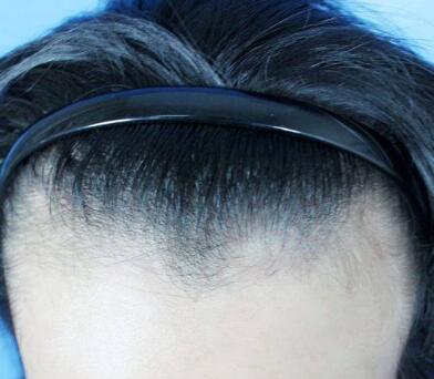 北京碧莲盛植发际线效果怎么样 适宜人群有哪些