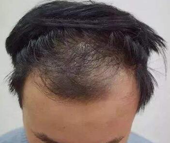 植发的脱落期是什么时候 成都新生植发种植发际线怎么样