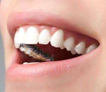 西安莲湖圣贝口腔整形医院做牙齿整形一般多少钱