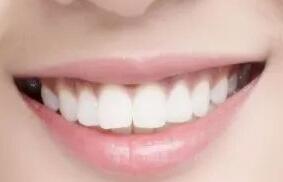 西安莲湖圣贝口腔医院矫正牙齿 年龄并不是限制因素