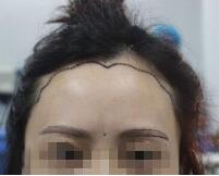 太原丽都植美人尖效果如何 有没有风险
