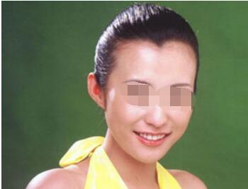 石家庄植发排名  石家庄雍禾植发医院美人尖种植安全吗