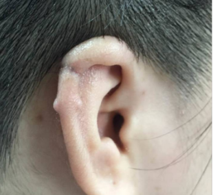 广州军美整形医院做耳部整形贵吗 耳朵畸形有哪些
