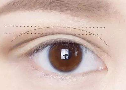 威海做双眼皮手术哪好 全切双眼皮有后遗症吗