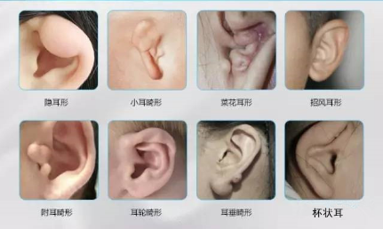 北京南加整形医院做耳部畸形矫正好吗 耳廊畸形有哪些