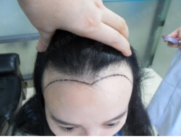 青岛海伦植发头发的种植效果怎样 发际线调整有风险吗