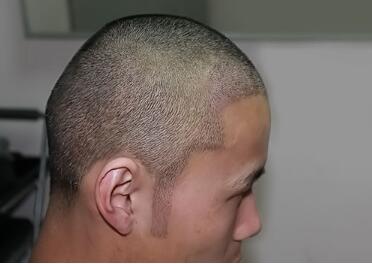 沈阳市天桥中医院植发科靠谱吗 鬓角种植需要多少钱