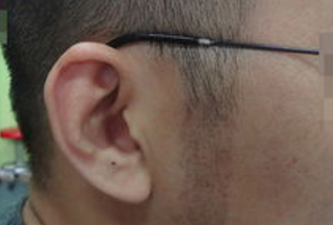 鬓角移植好不好 武警辽宁省总队医院植发整形科正规吗