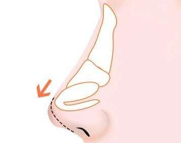 温州加美整形医院歪鼻矫正术的优点有哪些 重塑自信美鼻