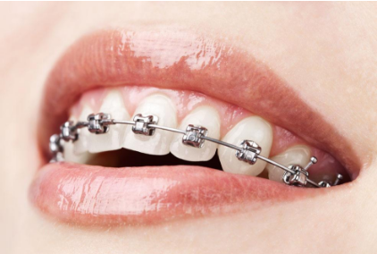 合肥成年人牙齿矫正需多少钱 牙齿畸形有什么危害