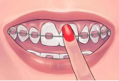 广州德伦口腔整形医院牙齿矫正效果如何 有哪些要点呢