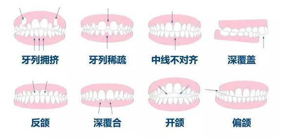 上海做牙齿不齐矫正多少钱 牙齿矫正后会反弹吗