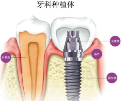 上海圣贝口腔医院种植牙多少钱 种植牙不成功的原因有哪些