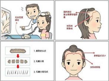 广州碧莲盛无痕植发医院发际线种植有哪些优势 有副作用吗