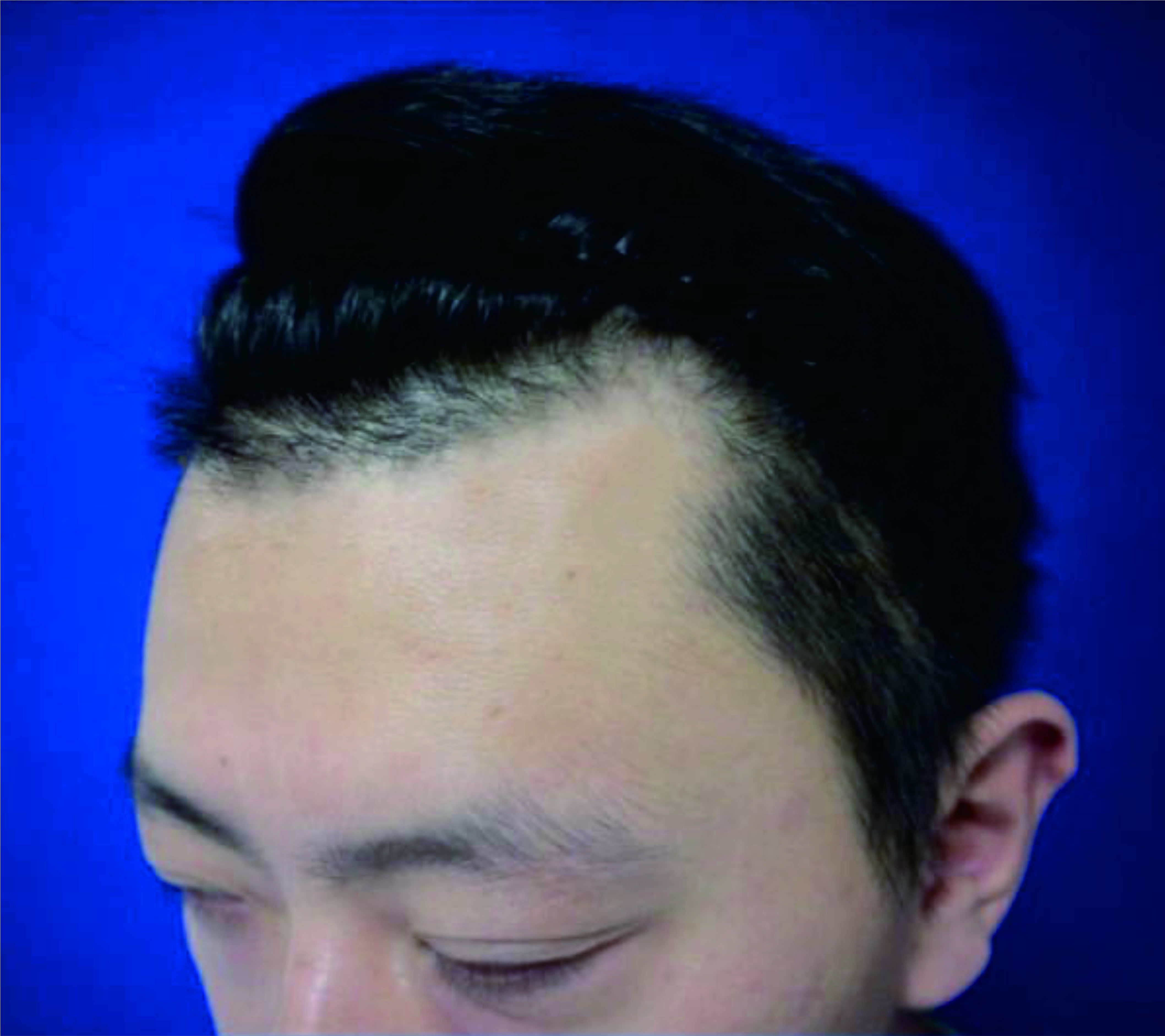 重庆华美整形医院植发科给了我自信 彻底改变了高高的额角