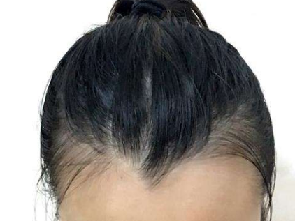 武汉做美人尖种植费用是多少 美人尖种植头发优势