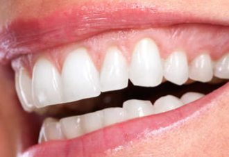 南京牙仙子口腔诊所做牙齿正畸要多少钱 牙不齐怎么矫正