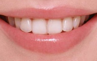 杭州至恒口腔门诊部牙齿隐形矫正价钱多少 矫正牙齿贵吗