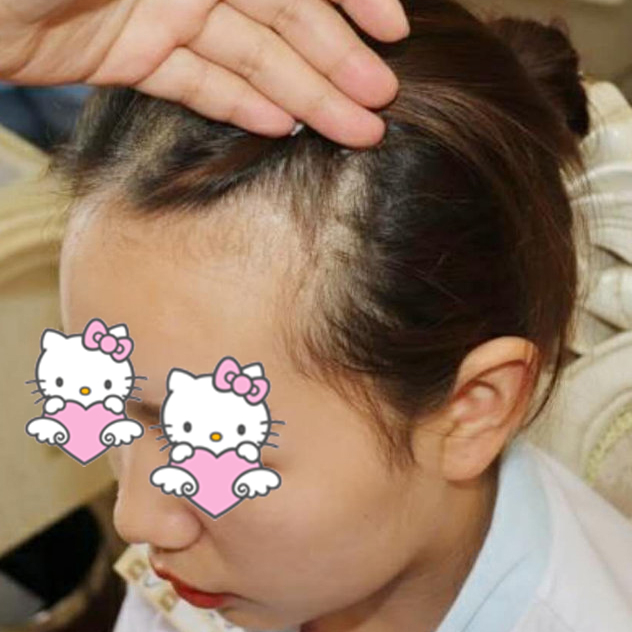 北京壹加壹植发整形医院发际线种植案例 告别秃头的困扰