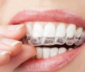上海牙齿隐形矫正术 让您摆脱“铁齿铜牙”的矫正技术