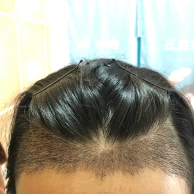 广州新发现植发整形医院植发案例 给了我美美的发际线 