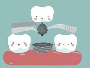 上海德伦口腔整形医院种植牙材料如何选 过程是怎样的