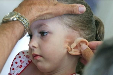 上海华美整形医院小耳畸形矫正术 让您拥有自然美观的耳朵 