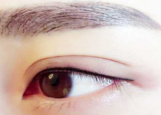 深圳雍禾植发医院眉毛种植的价格多少 眉毛种植适用哪些人