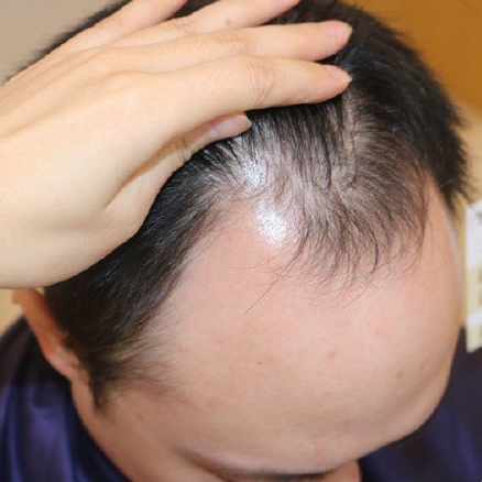 在杭州华山连天美医院植发科进行了头顶加密 让我更加自信