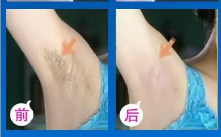 金华广福整形医院永久脱毛价格是多少 激光脱毛有后遗症吗