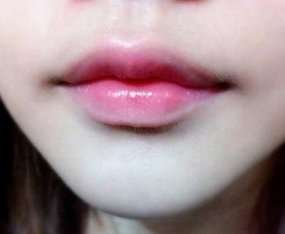 天津欧菲整形重唇整形的方法有哪些 会留疤吗