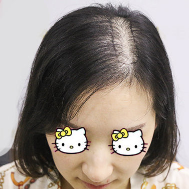 北京新面孔植发医院头顶加密种植案例 拥有浓密的秀发