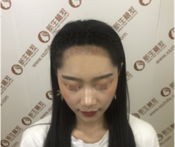 上海新生植发整形医院植发案例 改善我的大额头 恢复少女脸