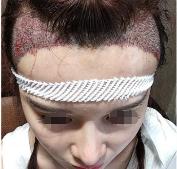 广州瑞丽诗植发医院发际线种植案例 拯救我的发际线