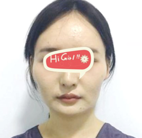 北京爱斯克整形医院下颌角磨骨案例分享 脸型美了好多