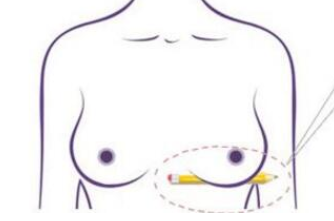 乳房松弛怎么办 洛阳谢景良整形医院乳房下垂矫正方法