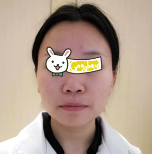 在杭州启美整形医院做磨骨整形后脸型好立体 我很满意