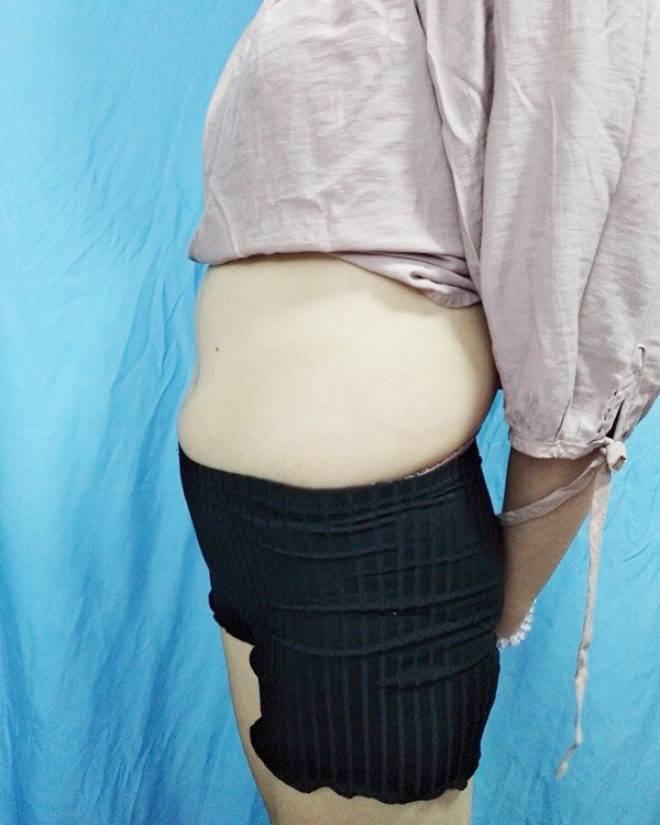 在北京尹林丽格整形医院做了腰部吸脂 让我这个宝妈重获新生